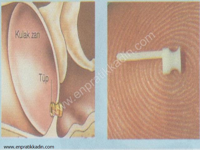 Çocuklarda Kulak Tıkanması ve Nedenleri