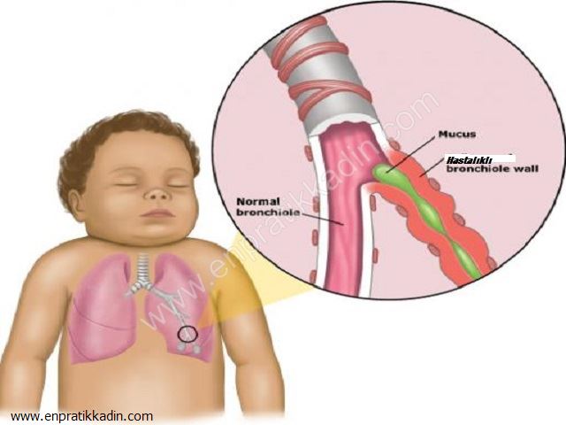 Bronşiolit Nedir, Çocuklarda Bronşiolit Tedavisi