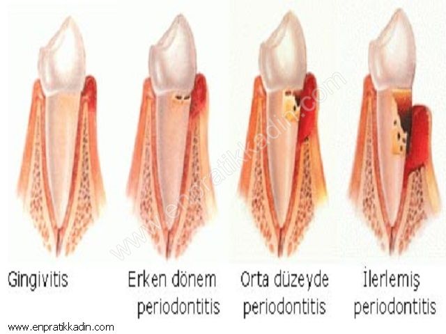 Diş Eti Hastalıkları