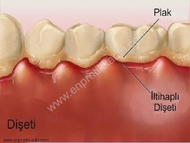 Diş Eti Hastalıklarının Nedenleri