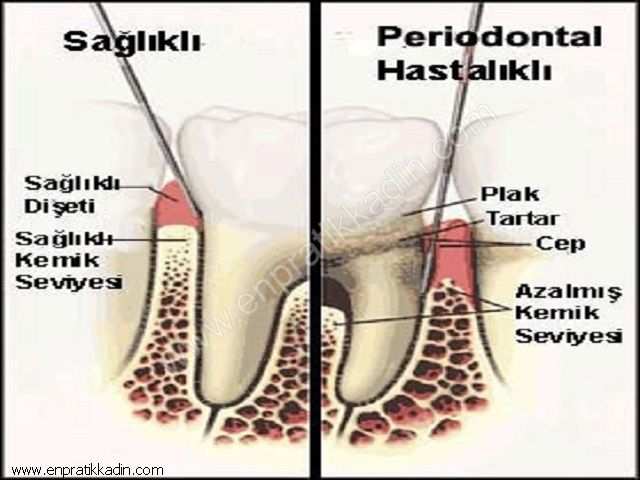 Diş Etlerinde Oluşan Bakteriler