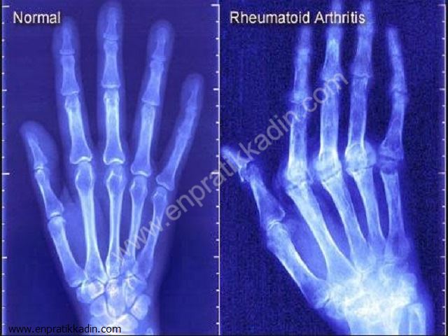 Romatoid Artrit Belirtileri ve İlaç Tedavisi
